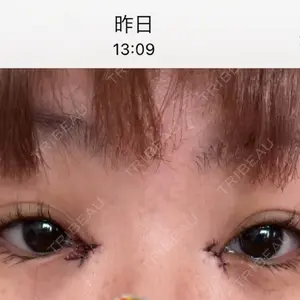 1 days after image