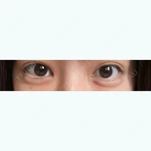 1 days after image