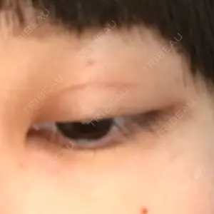 0 days after image