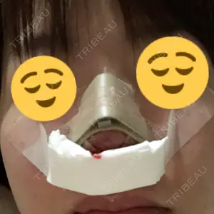 0 days after image