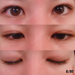 22 days after image