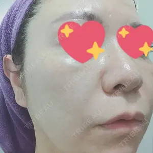 2 days after image