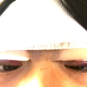 0 days after image