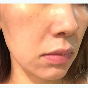 before image