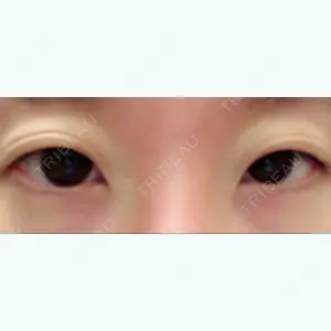 before image