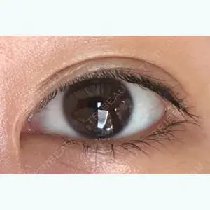 before image
