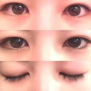 before image
