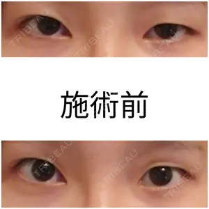 before image