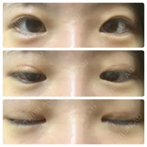before image
