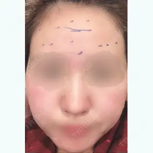 before image