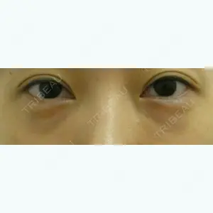 before image