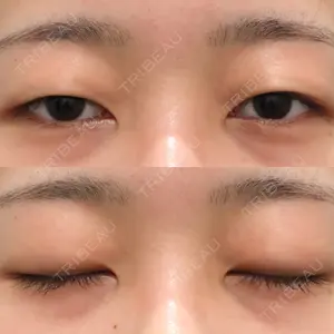before image