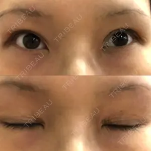 before image