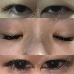 before image