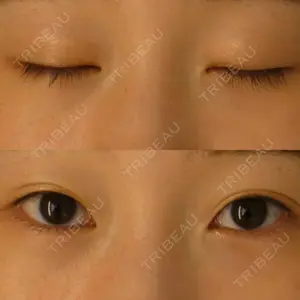 before image