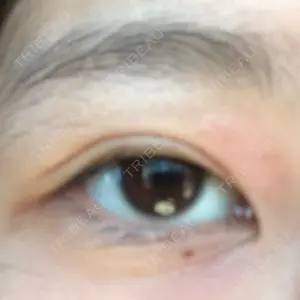 before image