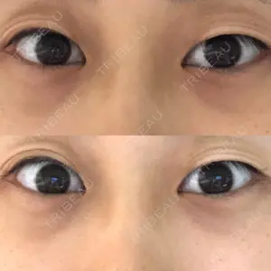 before image