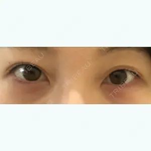 before image