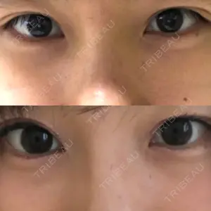 before image