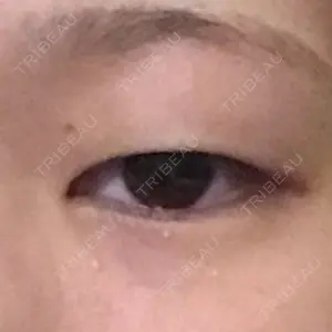before image
