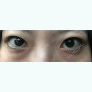 before image