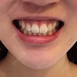 before image