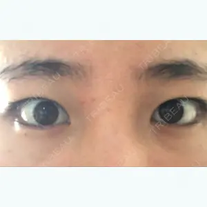 before image