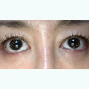 before image