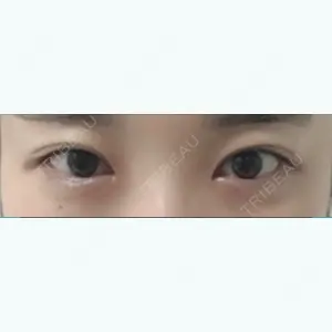 before image