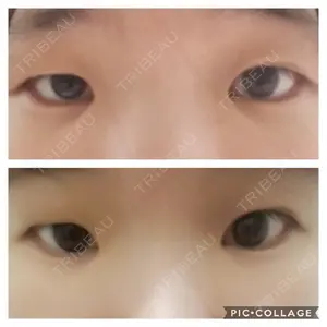 before image
