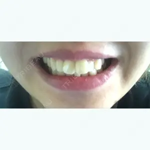 before image
