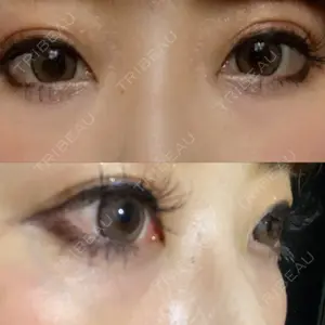 before image