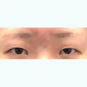 before image