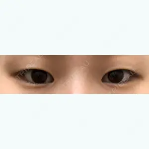 before image