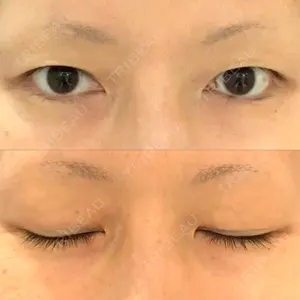 before image