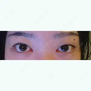 before image