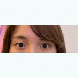 before image
