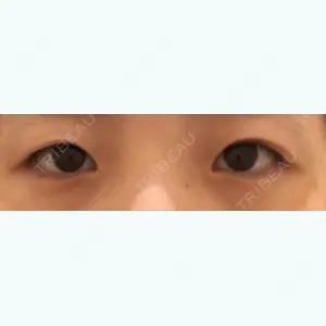 before image