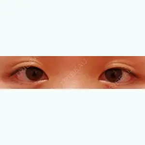 before image
