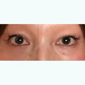 before image