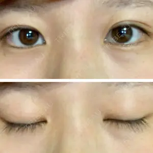 before image