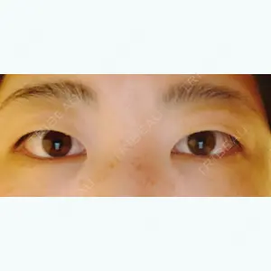 before image