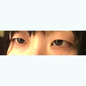before image
