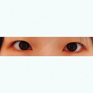 before image