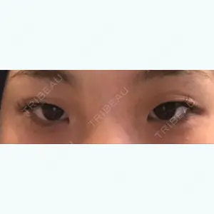 before image