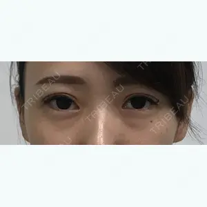 before image