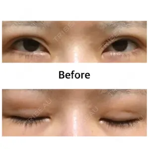 before image