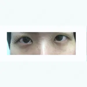 before image
