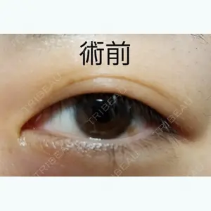 before image