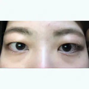 before image